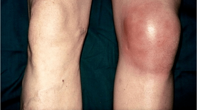 Arthrose et arthrite